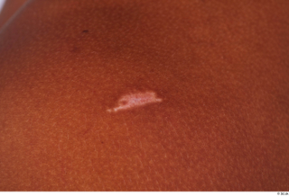 Nabil scar skin 0001.jpg